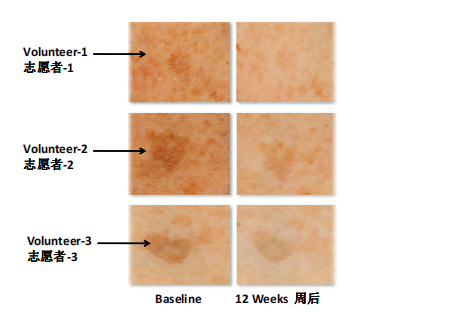 The skin pigment of volunteers was tested