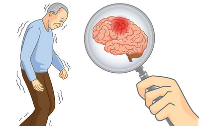 胞磷胆碱可以治疗脑卒中