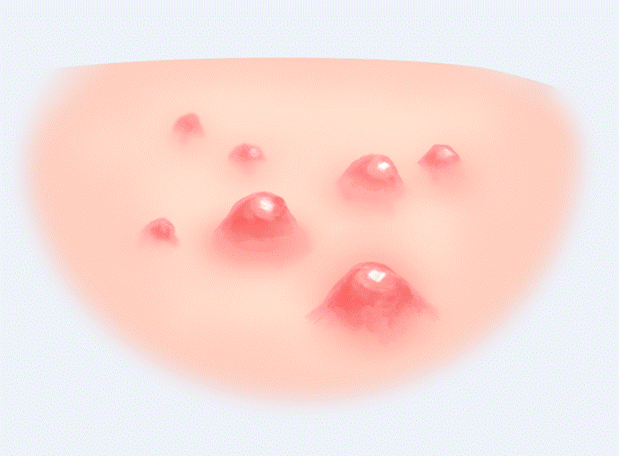 facial seborrheic dermatitis 