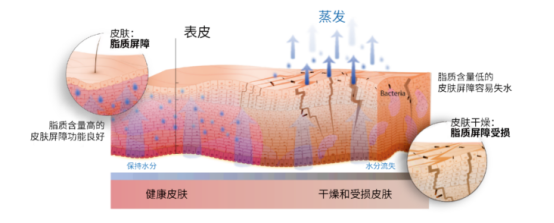 冬季皮肤容易出现干燥、紧绷、粗糙原理图
