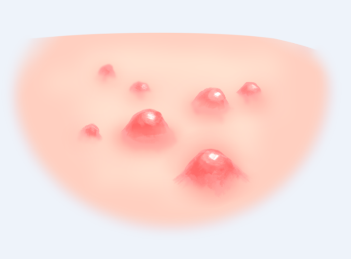 面部脂溢性皮炎